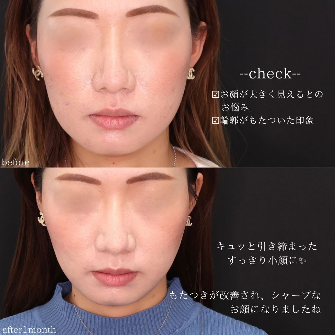 TAC式 ツヤ肌コラーゲンリフト®/エラボトックス注射の症例写真 施術前後 