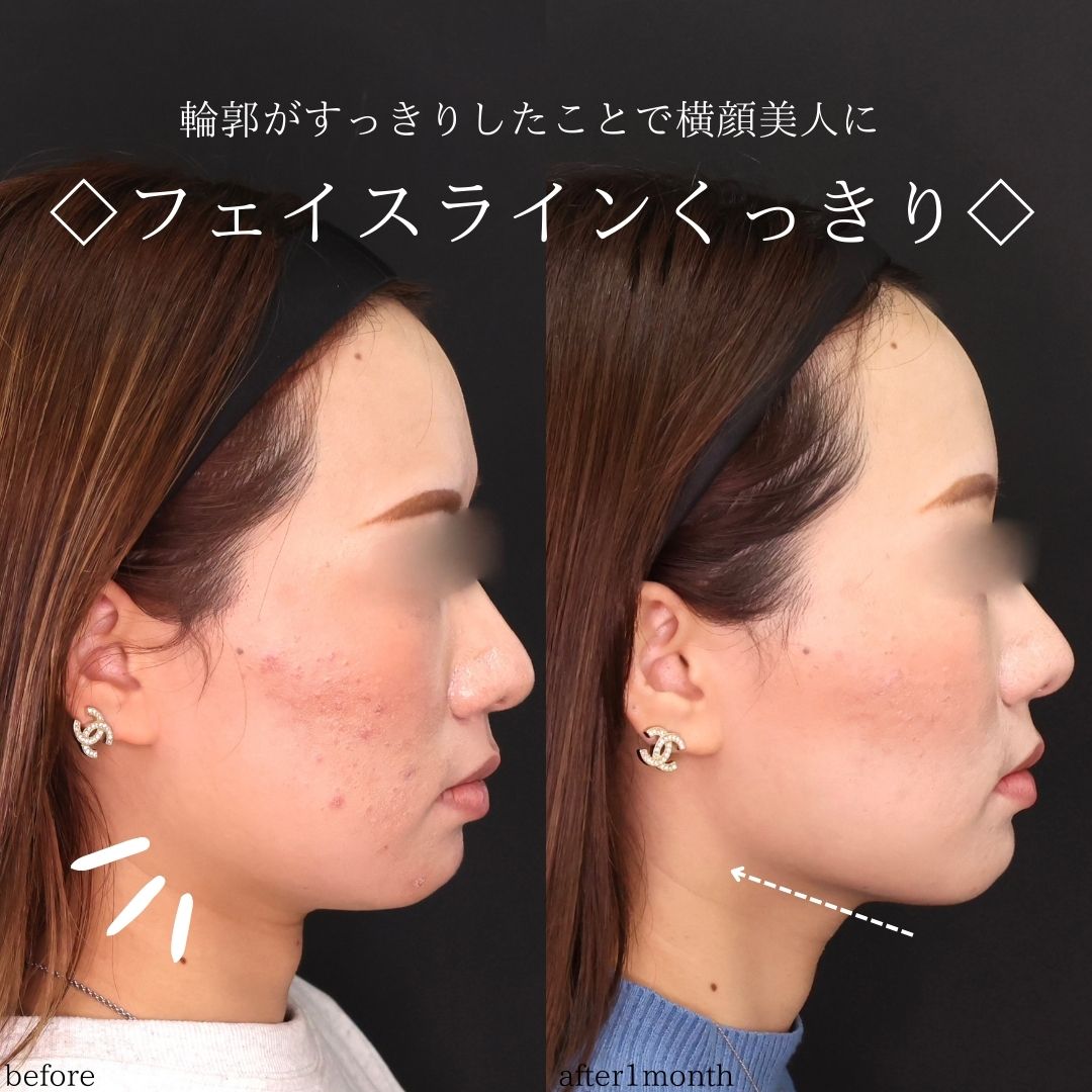 TAC式 ツヤ肌コラーゲンリフト®/エラボトックス注射の症例写真 施術前後 