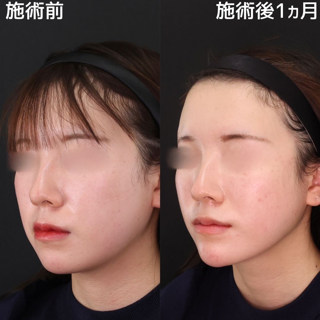 TAC式 ツヤ肌コラーゲンリフト®/顔の脂肪吸引/エラボトックス注射の症例写真 施術前後