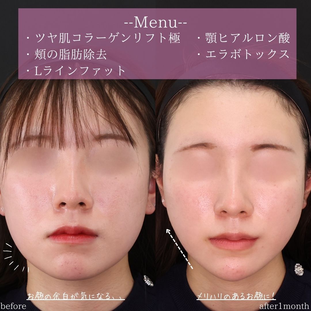 TAC式 ツヤ肌コラーゲンリフト®/顔の脂肪吸引/エラボトックス注射の症例写真 施術前後
