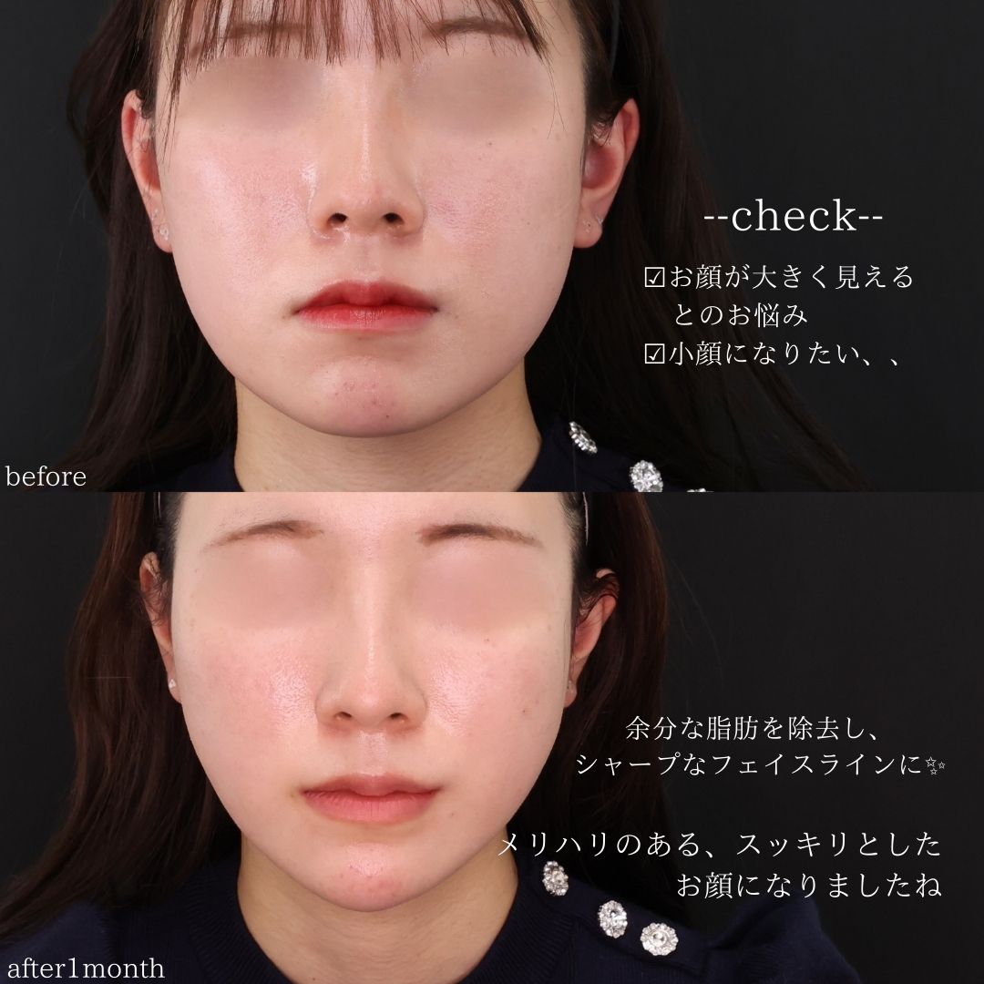 TAC式 ツヤ肌コラーゲンリフト®/顔の脂肪吸引/エラボトックス注射の症例写真 施術前後