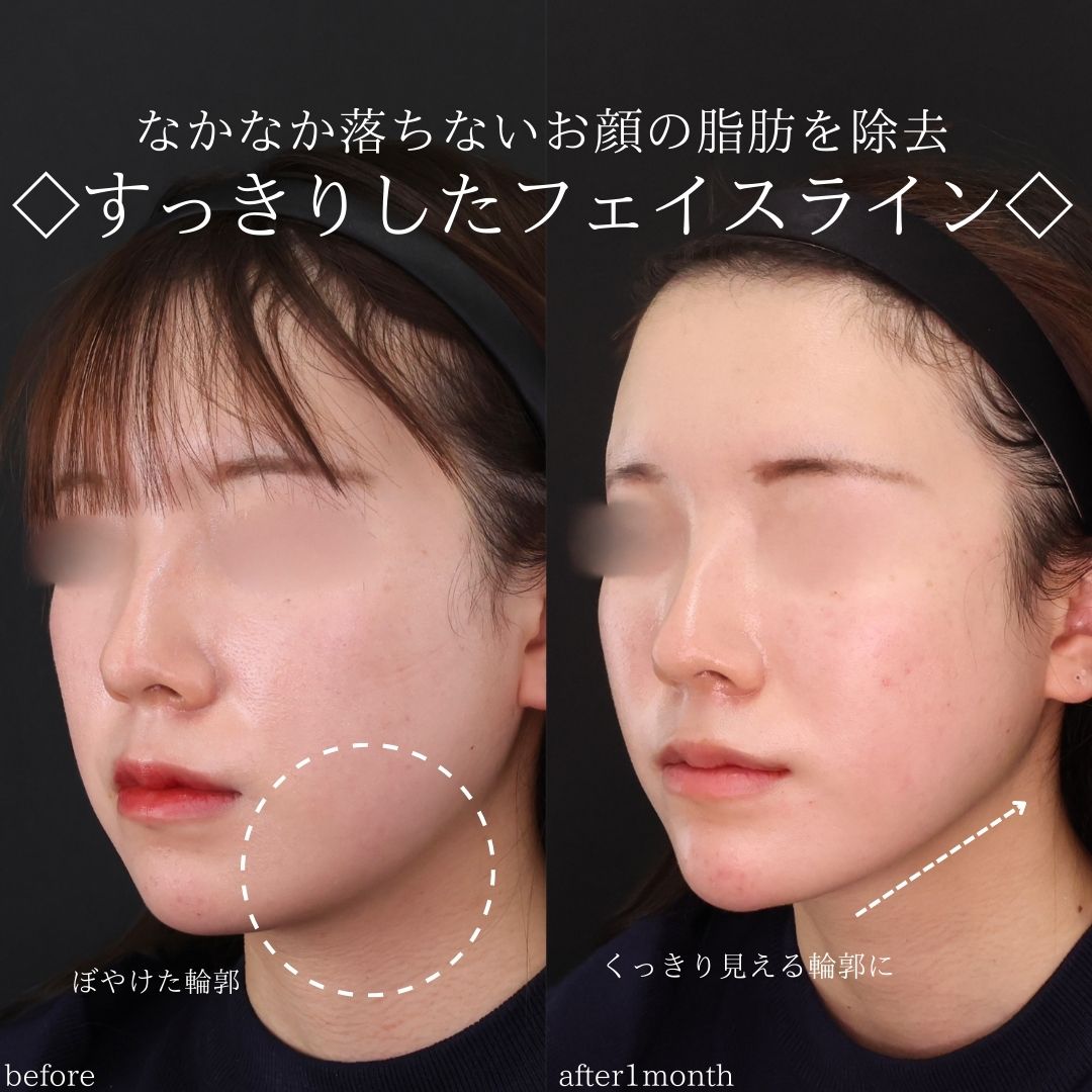 TAC式 ツヤ肌コラーゲンリフト®/顔の脂肪吸引/エラボトックス注射の症例写真 施術前後