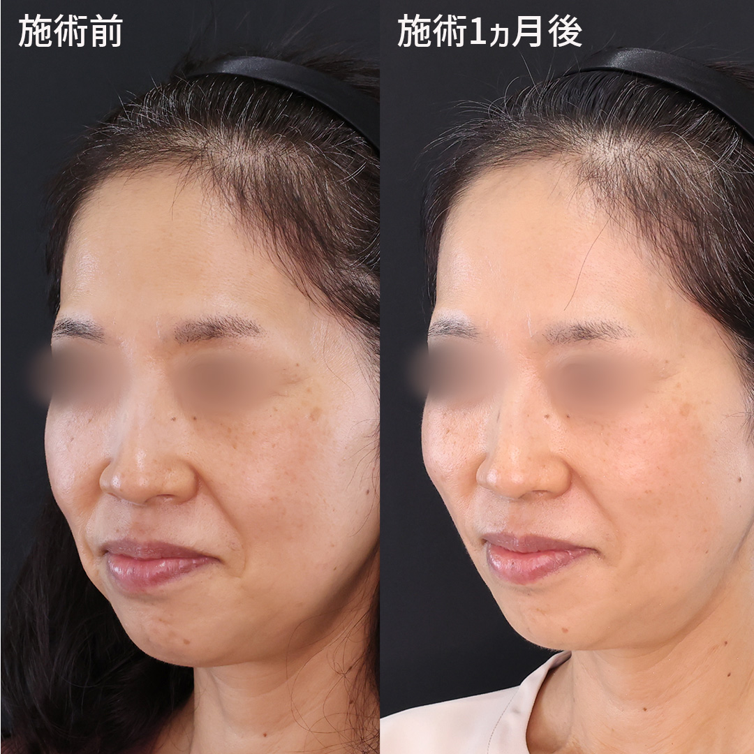 TAC式 ツヤ肌コラーゲンリフト®/ジョールファット除去の症例写真 施術前後 