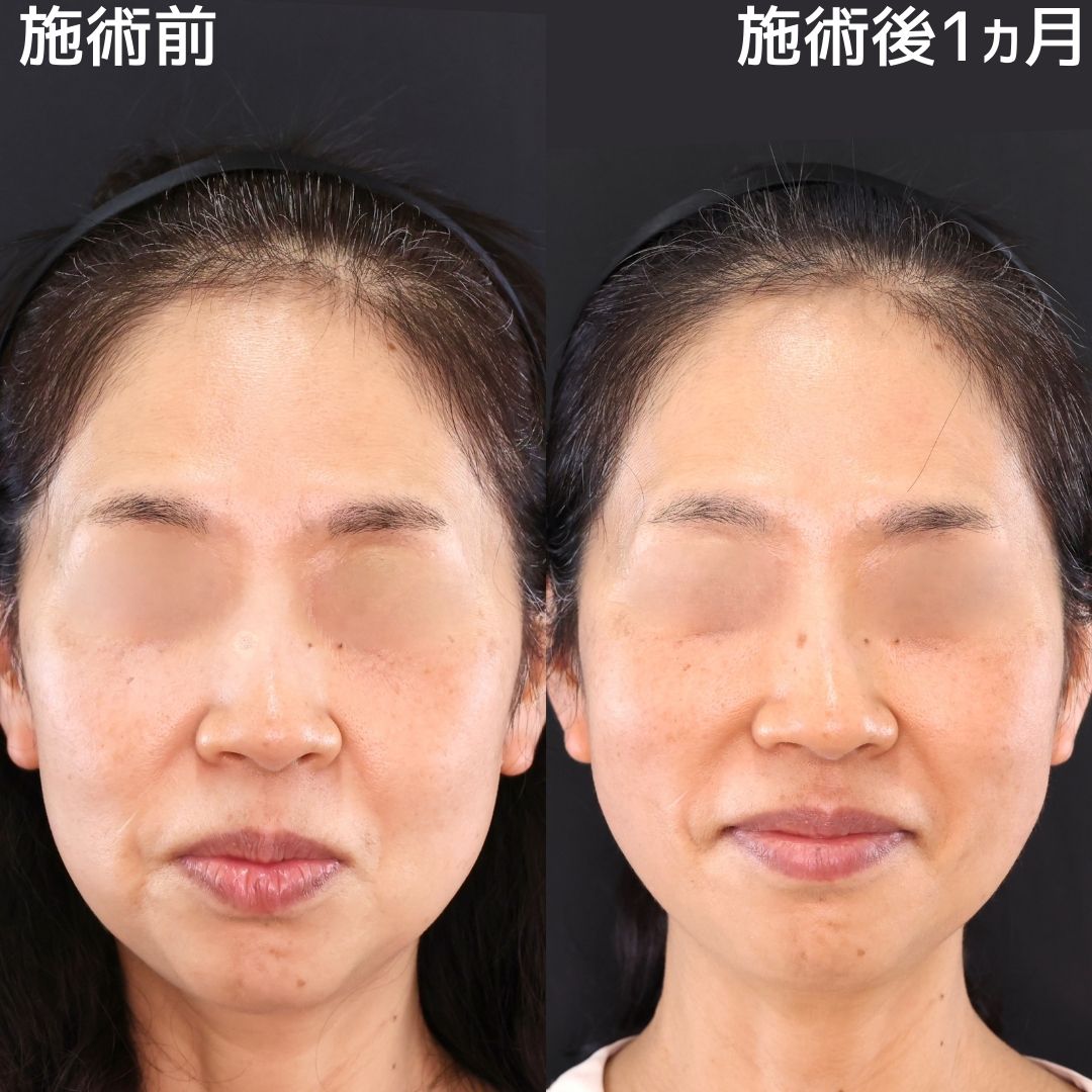 引き締まった小顔で若々しい印象に【糸リフト×脂肪除去】