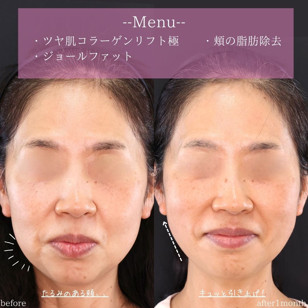 TAC式 ツヤ肌コラーゲンリフト®/ジョールファット除去の症例写真 施術前後 