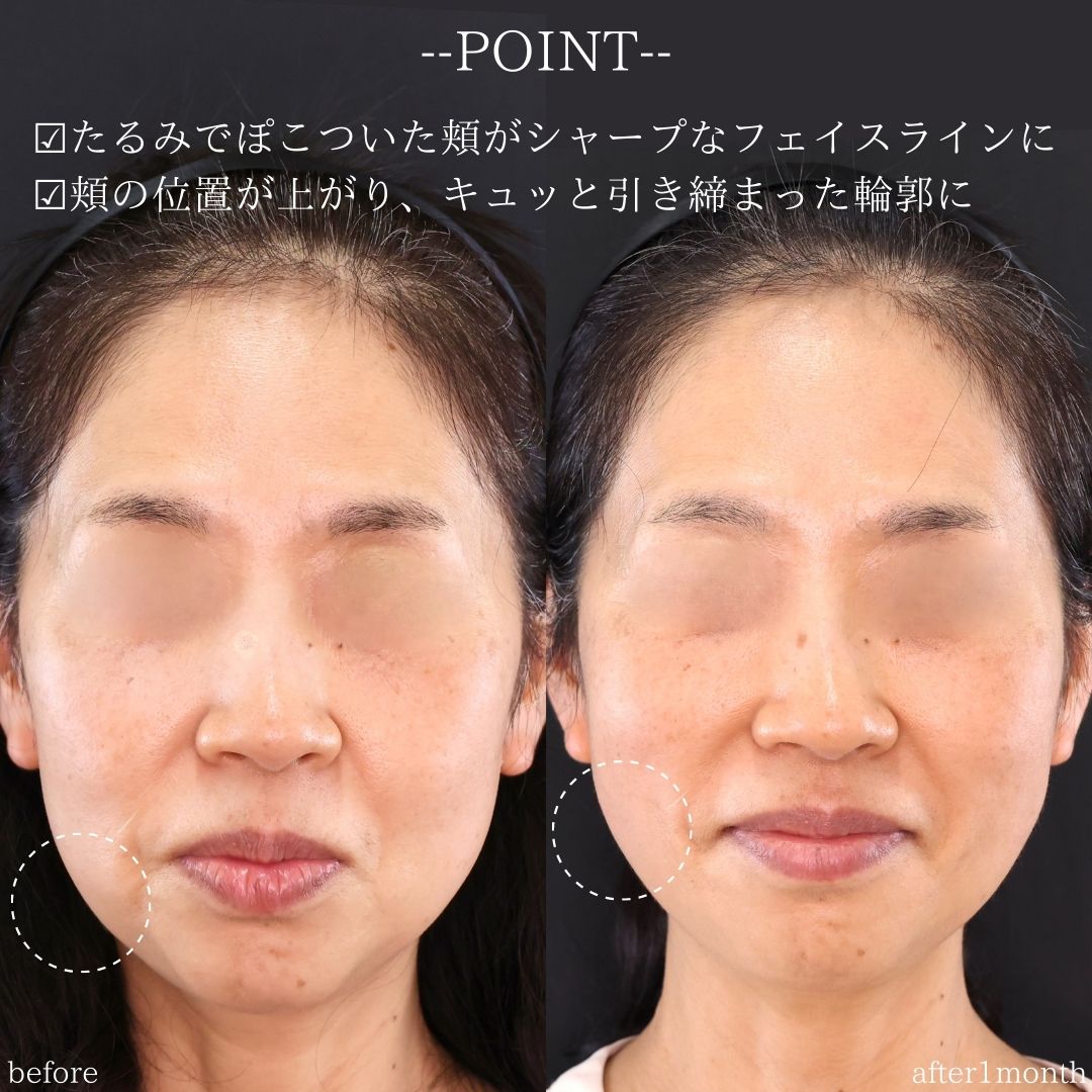 TAC式 ツヤ肌コラーゲンリフト®/ジョールファット除去の症例写真 施術前後 