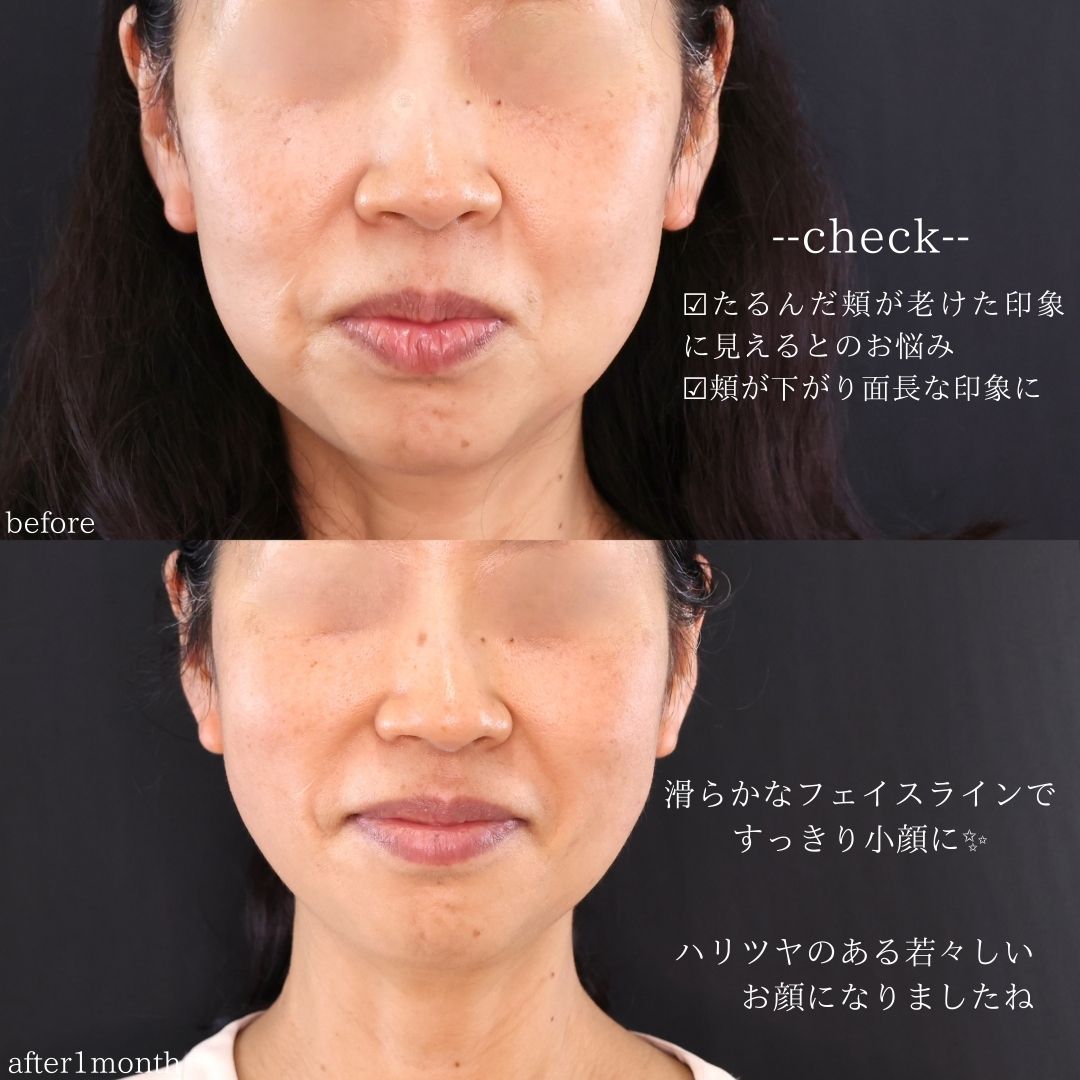 TAC式 ツヤ肌コラーゲンリフト®/ジョールファット除去の症例写真 施術前後 