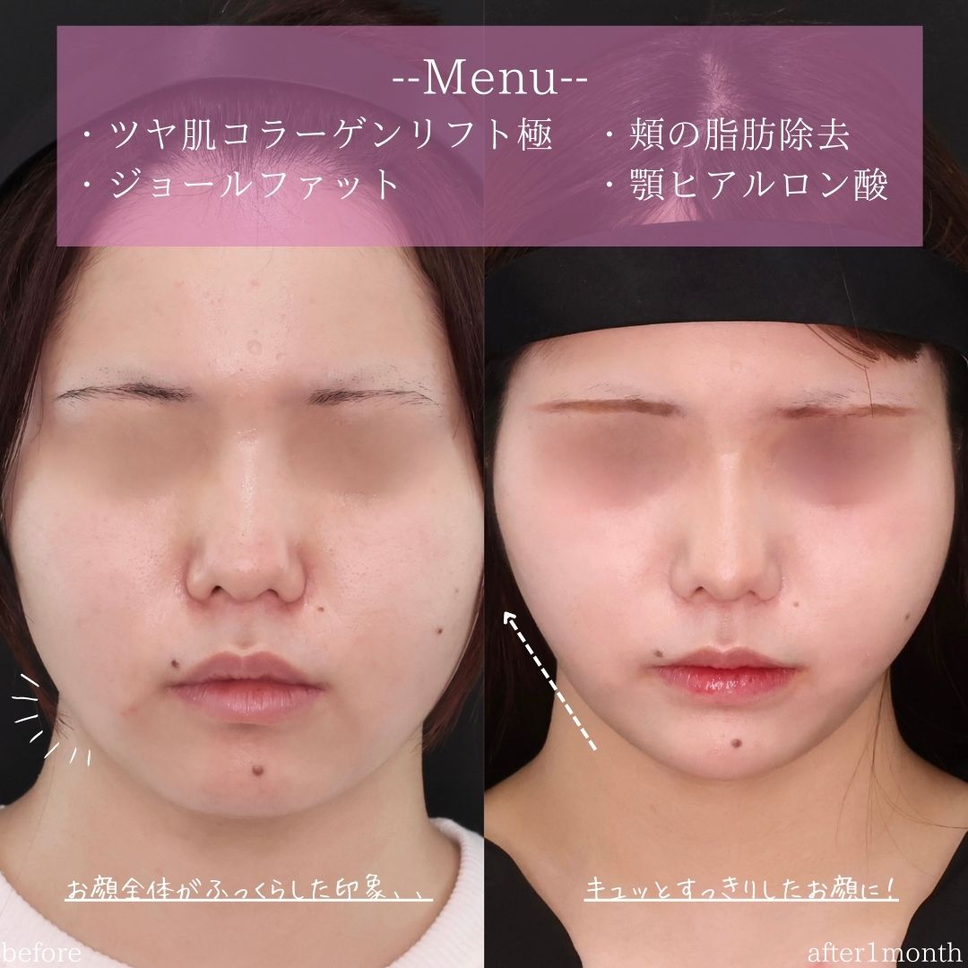 TAC式 ツヤ肌コラーゲンリフト®/ジョールファット除去/顎のヒアルロン酸注射の症例写真 施術前後 