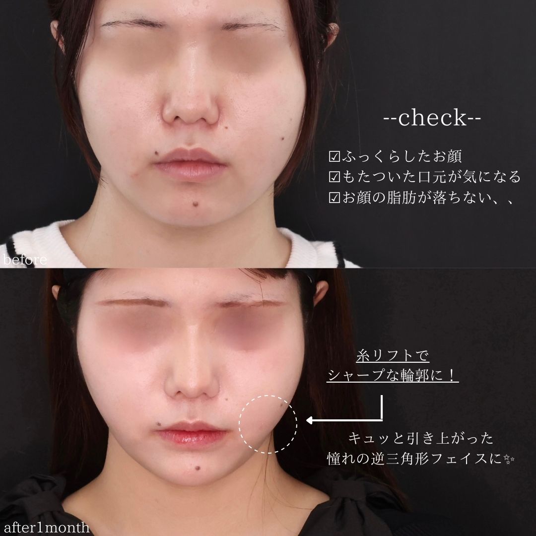 TAC式 ツヤ肌コラーゲンリフト®/ジョールファット除去/顎のヒアルロン酸注射の症例写真 施術前後 