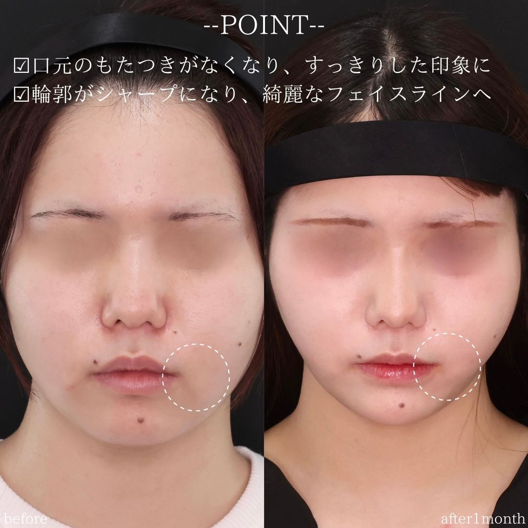 TAC式 ツヤ肌コラーゲンリフト®/ジョールファット除去/顎のヒアルロン酸注射の症例写真 施術前後 