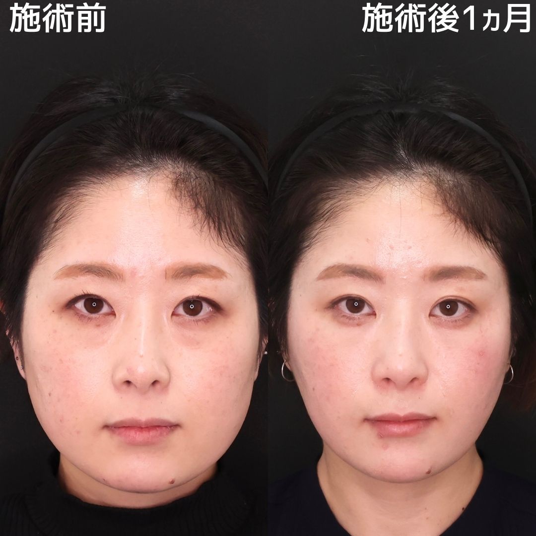 【下眼瞼脱脂術×糸リフト】で若々しいすっきりとした小顔に!