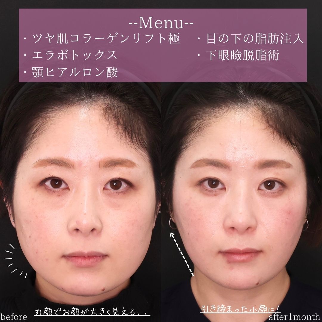TAC式 ツヤ肌コラーゲンリフト®/エラボトックス注射/顎のヒアルロン酸注射の症例写真 施術前後 