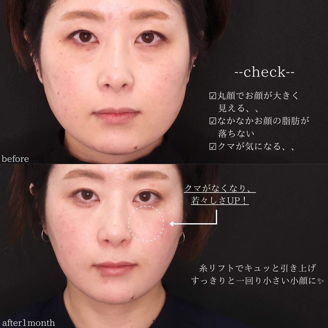 TAC式 ツヤ肌コラーゲンリフト®/エラボトックス注射/顎のヒアルロン酸注射の症例写真 施術前後 