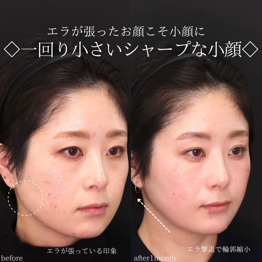 TAC式 ツヤ肌コラーゲンリフト®/エラボトックス注射/顎のヒアルロン酸注射の症例写真 施術前後 