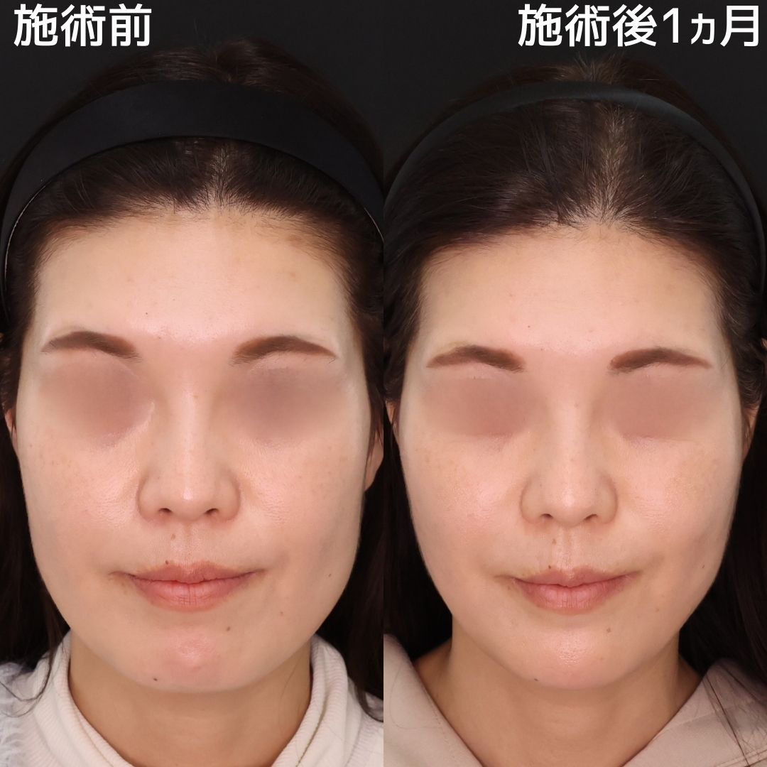 糸リフト×ヒアルロン酸ですっきりとした輪郭に