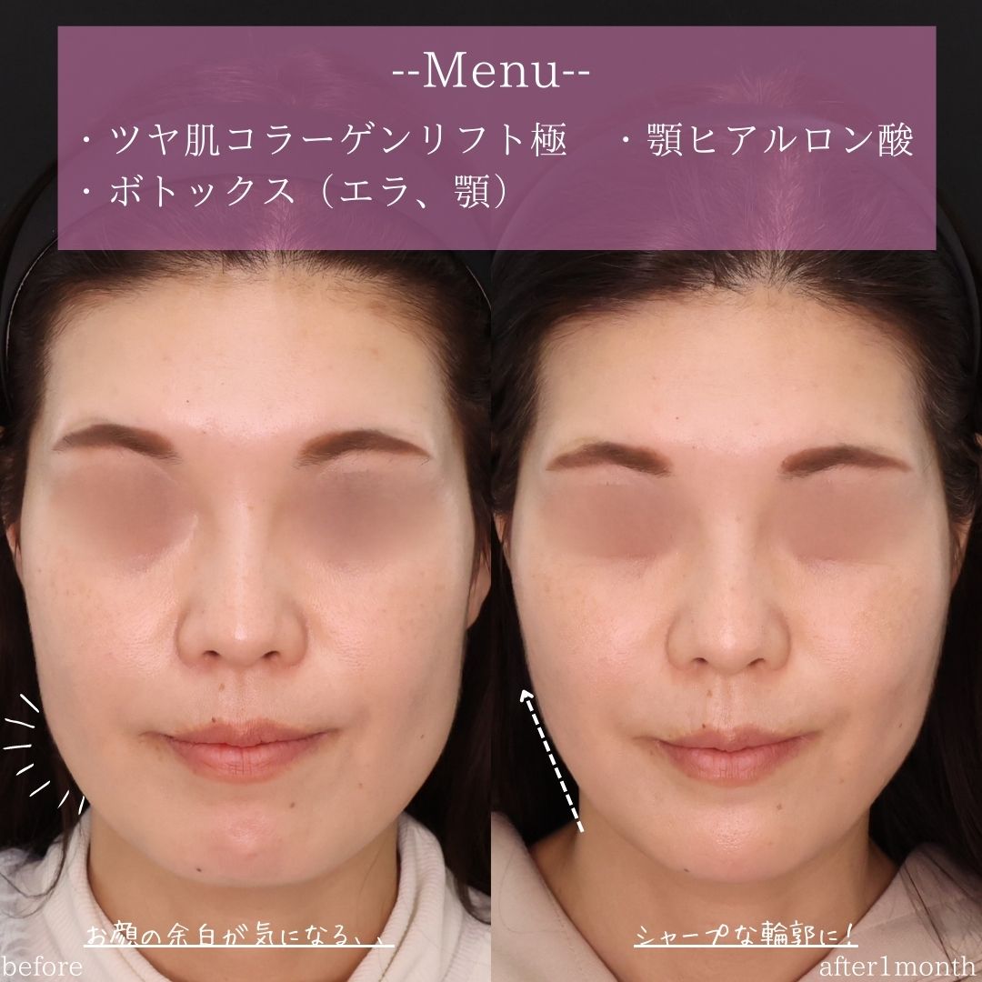 TAC式 ツヤ肌コラーゲンリフト®/エラボトックス注射/顎のヒアルロン酸注射の症例写真 施術前後 