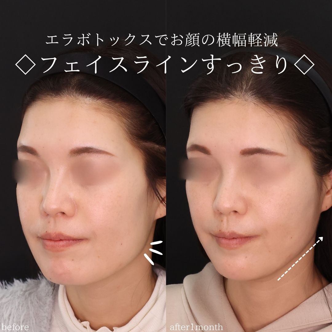 TAC式 ツヤ肌コラーゲンリフト®/エラボトックス注射/顎のヒアルロン酸注射の症例写真 施術前後 