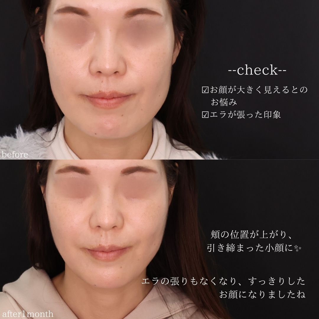 TAC式 ツヤ肌コラーゲンリフト®/エラボトックス注射/顎のヒアルロン酸注射の症例写真 施術前後 