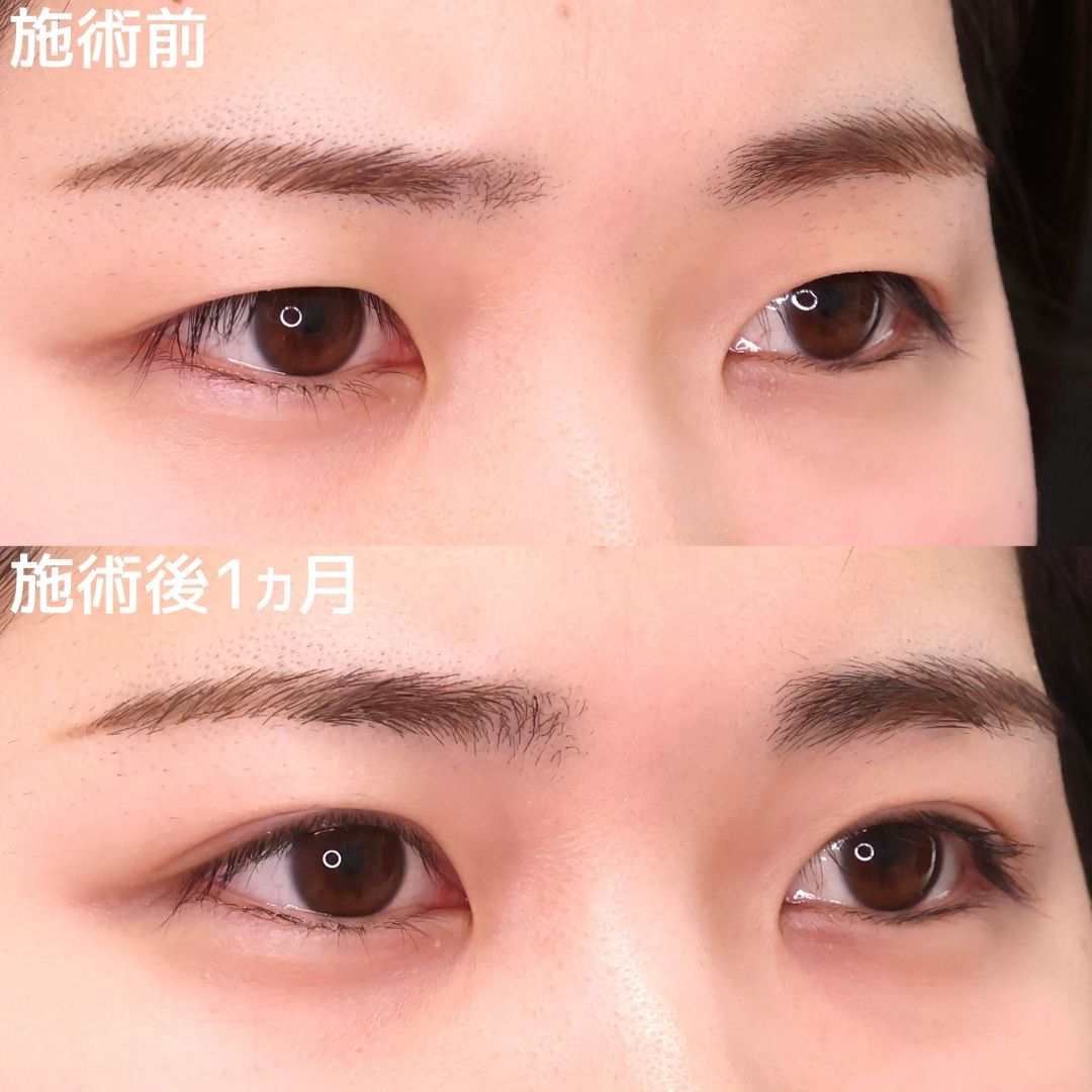 目の開き改善！可愛らしいぱっちり末広型二重