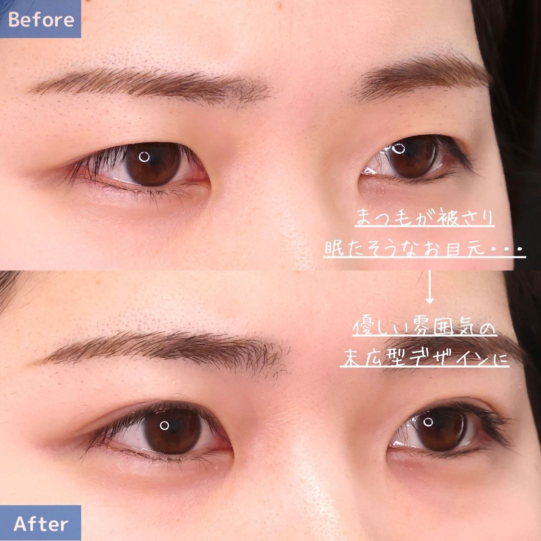 二重埋没法の症例写真 施術前後 