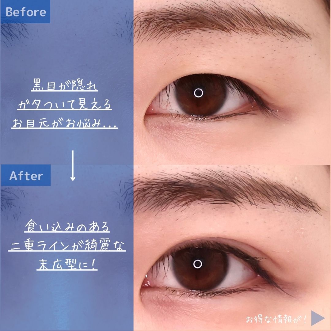 二重埋没法の症例写真 施術前後 