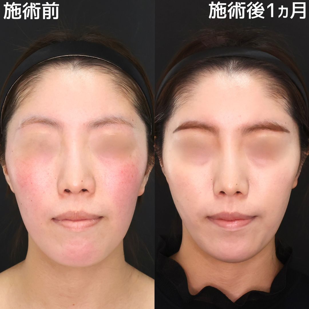 TAC式 ツヤ肌コラーゲンリフト®の症例写真 施術前後