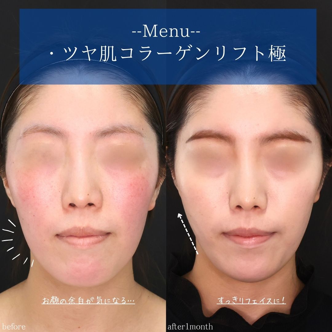 TAC式 ツヤ肌コラーゲンリフト®の症例写真 施術前後