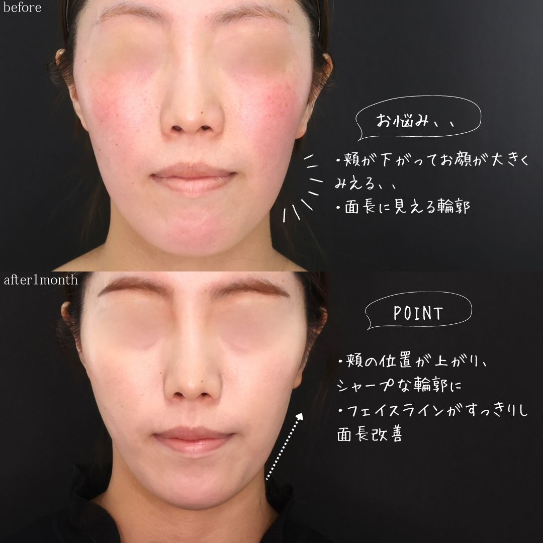 TAC式 ツヤ肌コラーゲンリフト®の症例写真 施術前後