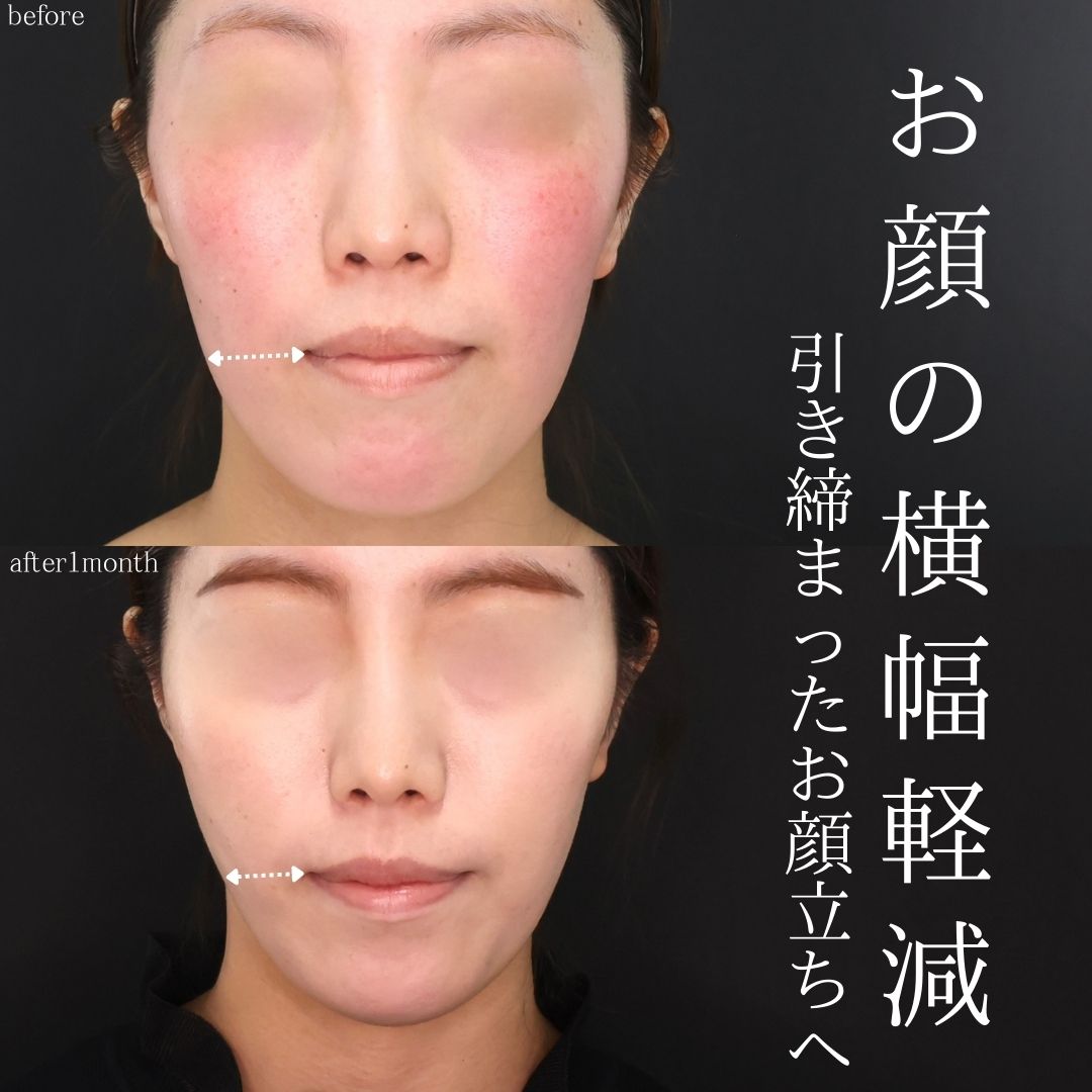 TAC式 ツヤ肌コラーゲンリフト®の症例写真 施術前後