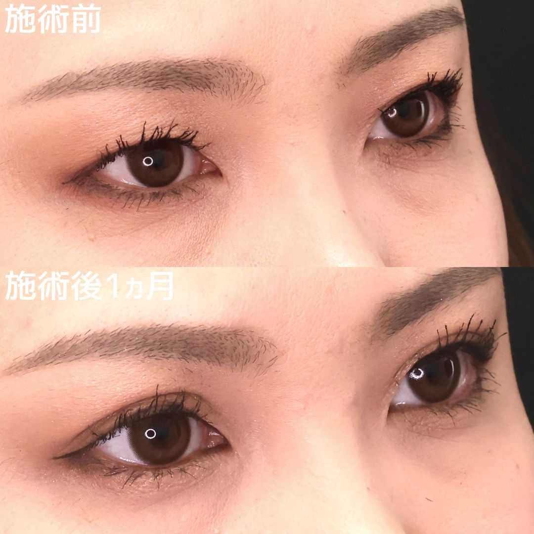 平行型二重でメイク映え抜群のお目元に！