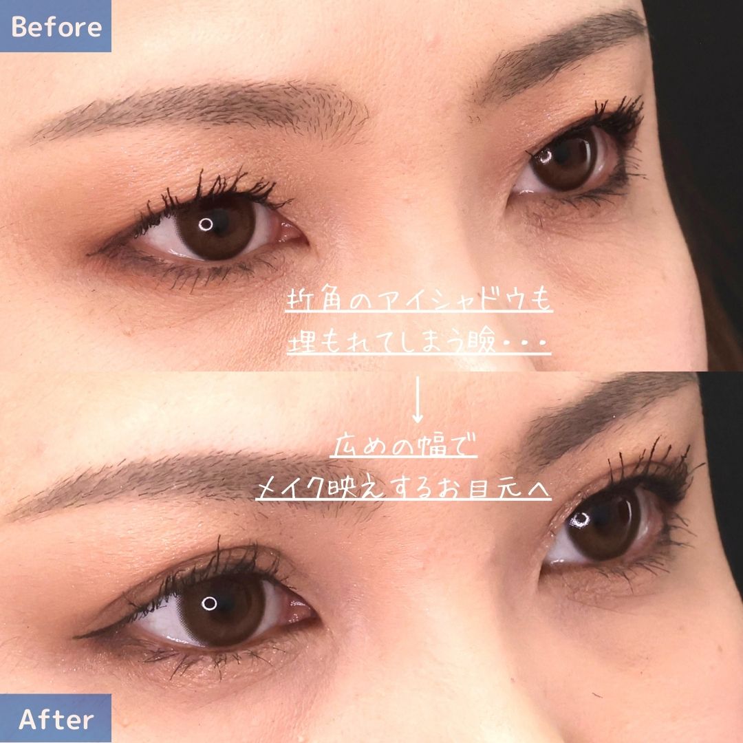 二重埋没法の症例写真 施術前後 