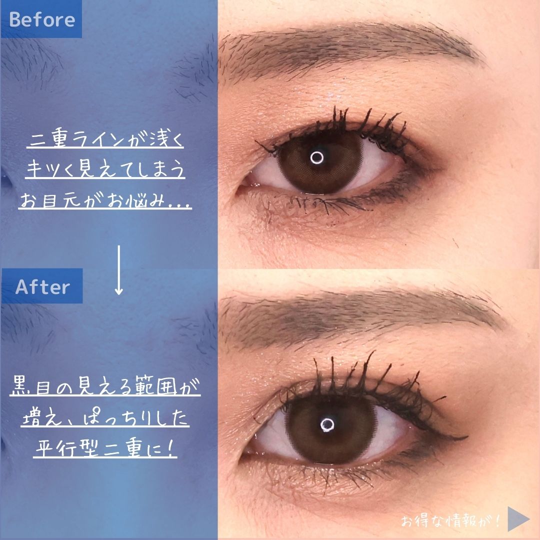 二重埋没法の症例写真 施術前後 