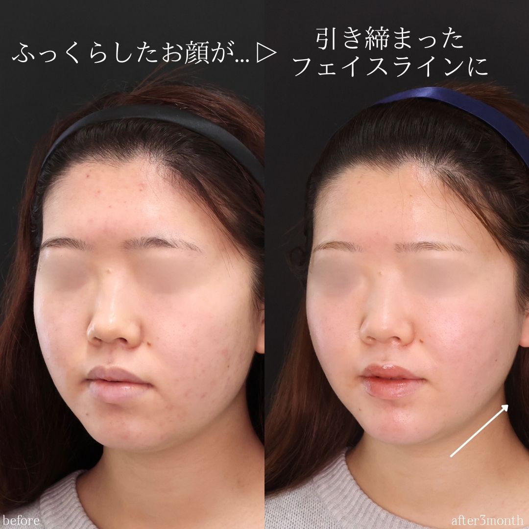 TAC式 ツヤ肌コラーゲンリフト®/ジョールファット除去/バッカルファット除去の症例写真 施術前後 
