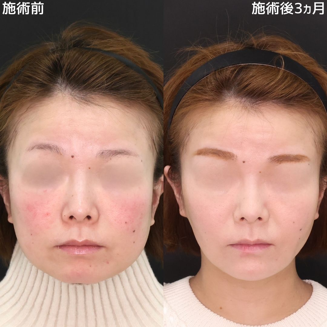 【糸リフト×脂肪除去】輪郭激変！すっきり小顔術