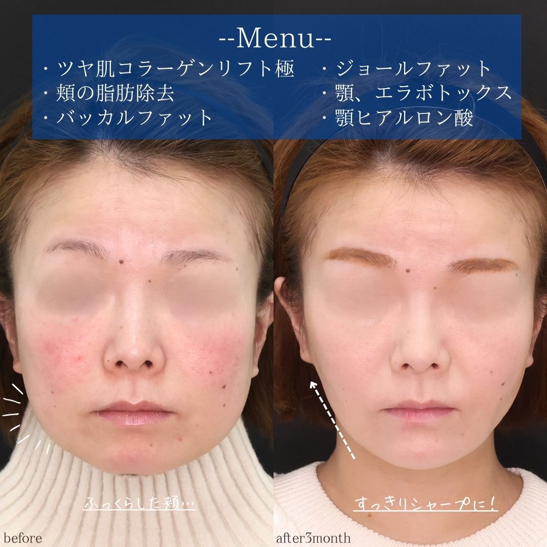 TAC式 ツヤ肌コラーゲンリフト®/ジョールファット除去/バッカルファット除去の症例写真 施術前後 