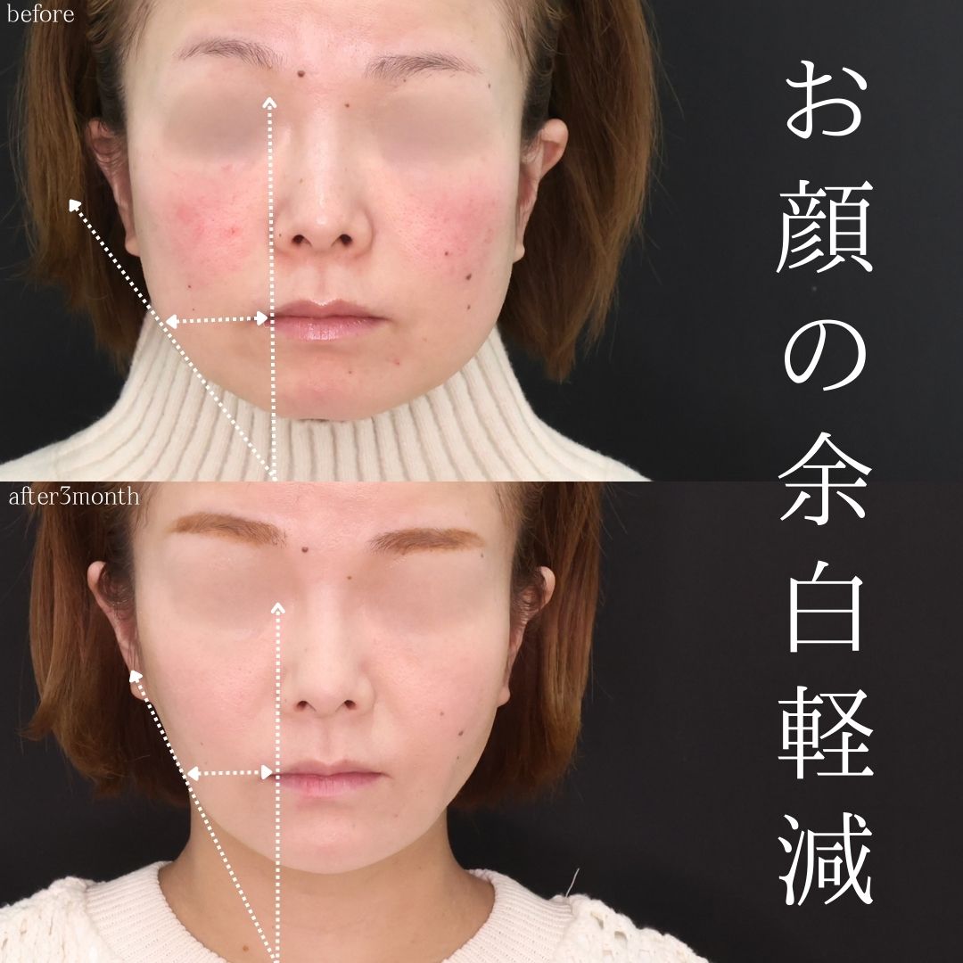 TAC式 ツヤ肌コラーゲンリフト®/ジョールファット除去/バッカルファット除去の症例写真 施術前後 