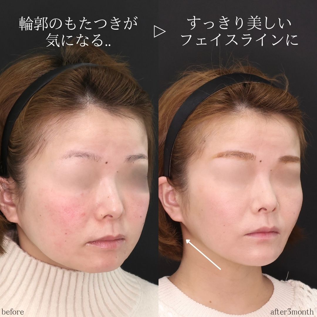 TAC式 ツヤ肌コラーゲンリフト®/ジョールファット除去/バッカルファット除去の症例写真 施術前後 