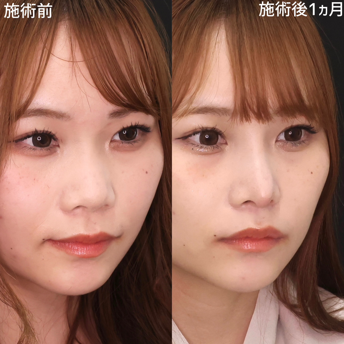 隆鼻術（プロテーゼ・自家組織）/鼻尖形成・鼻尖縮小/鼻先軟骨移植の症例写真 施術前後 