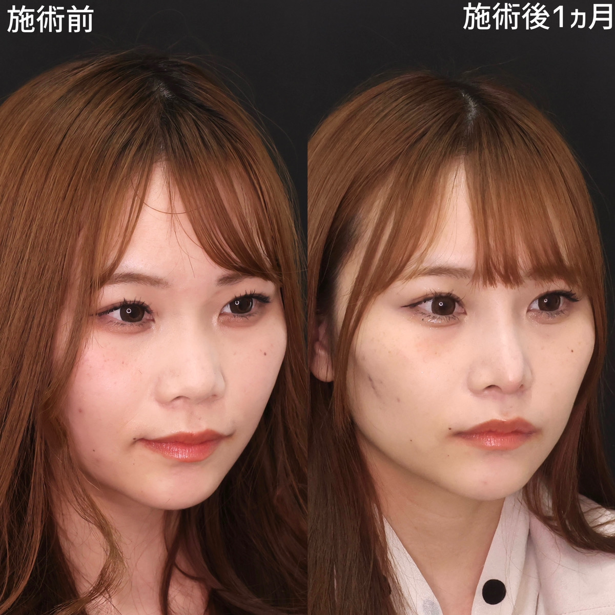 隆鼻術（プロテーゼ・自家組織）/鼻尖形成・鼻尖縮小/鼻先軟骨移植の症例写真 施術前後 