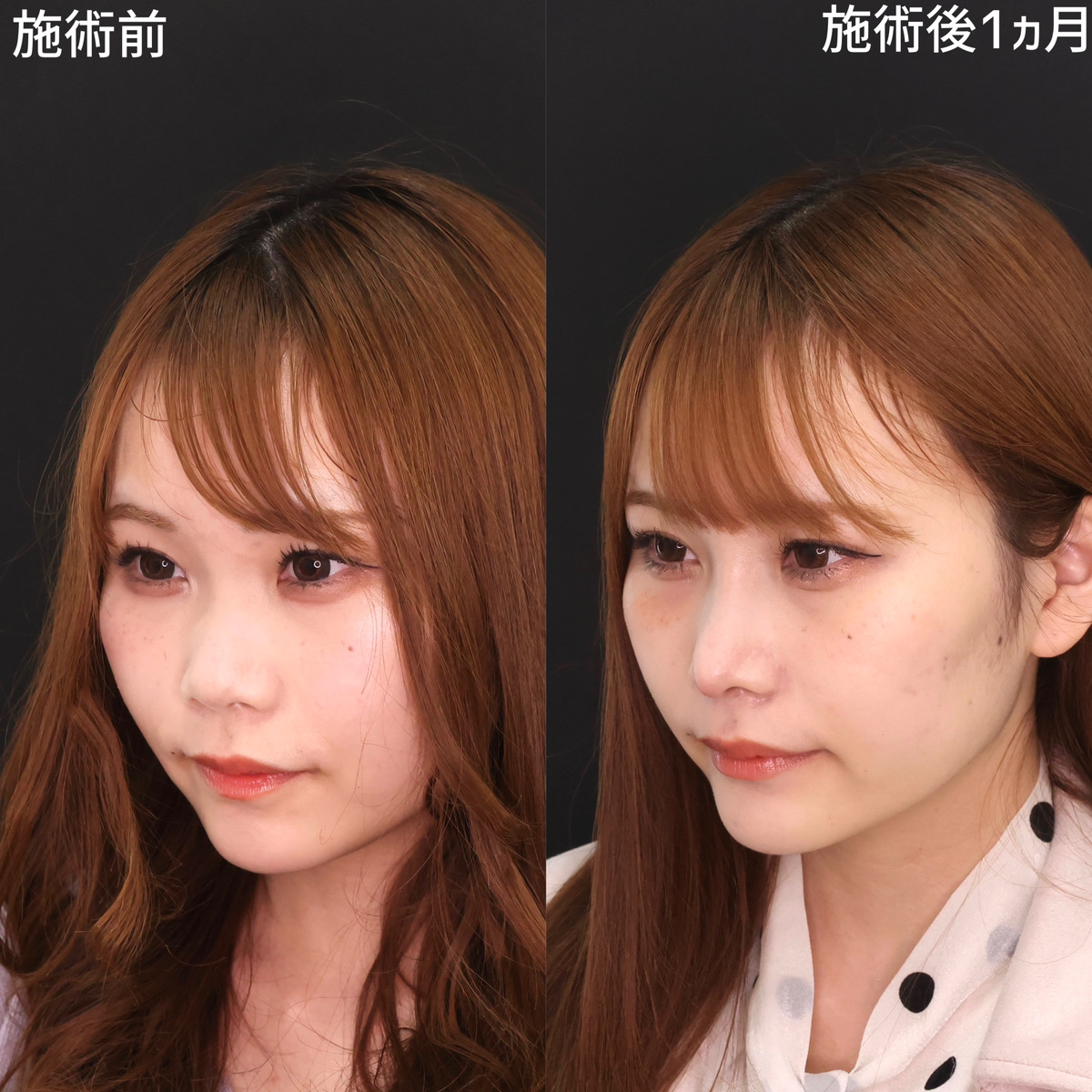 隆鼻術（プロテーゼ・自家組織）/鼻尖形成・鼻尖縮小/鼻先軟骨移植の症例写真 施術前後 