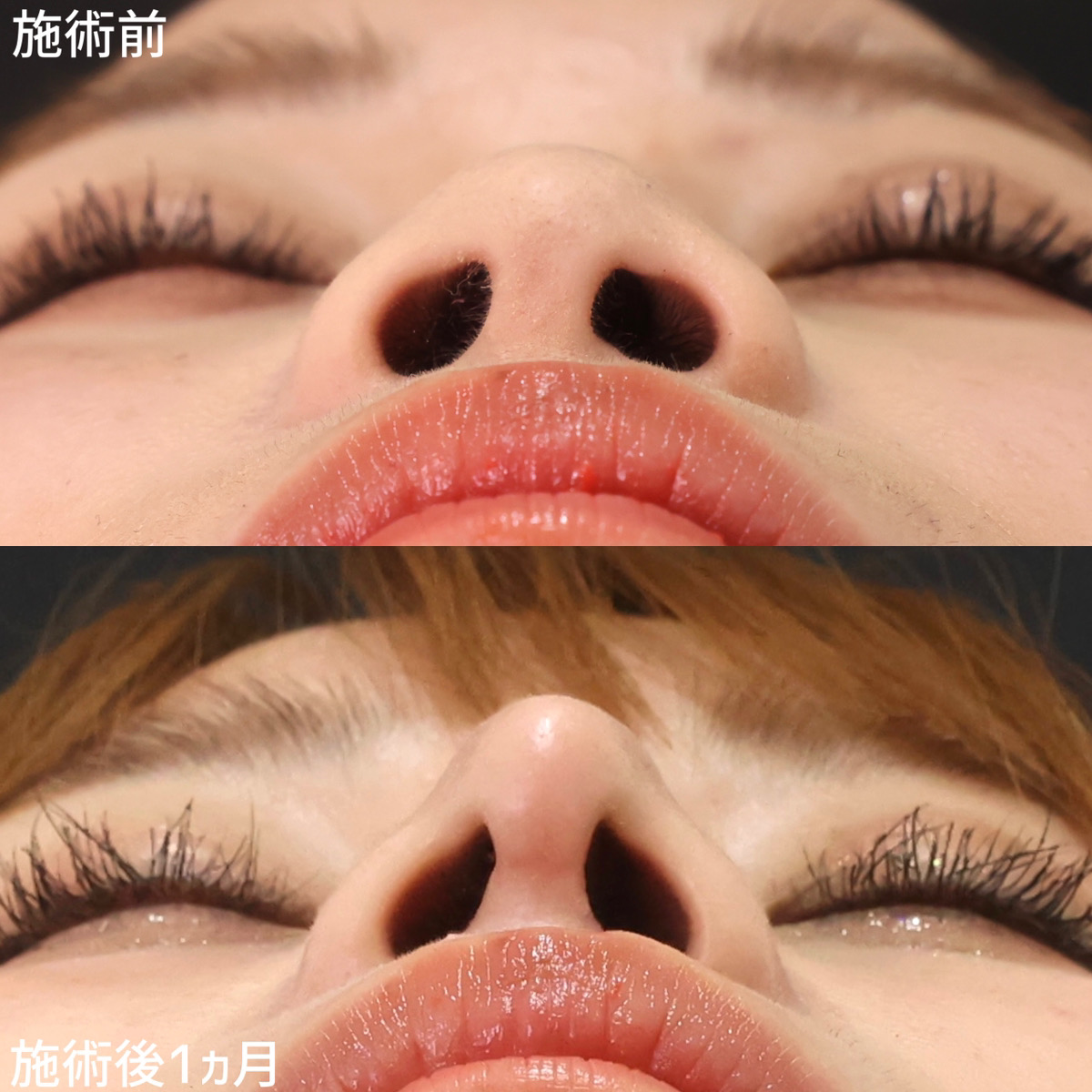 隆鼻術（プロテーゼ・自家組織）/鼻尖形成・鼻尖縮小/鼻先軟骨移植の症例写真 施術前後 