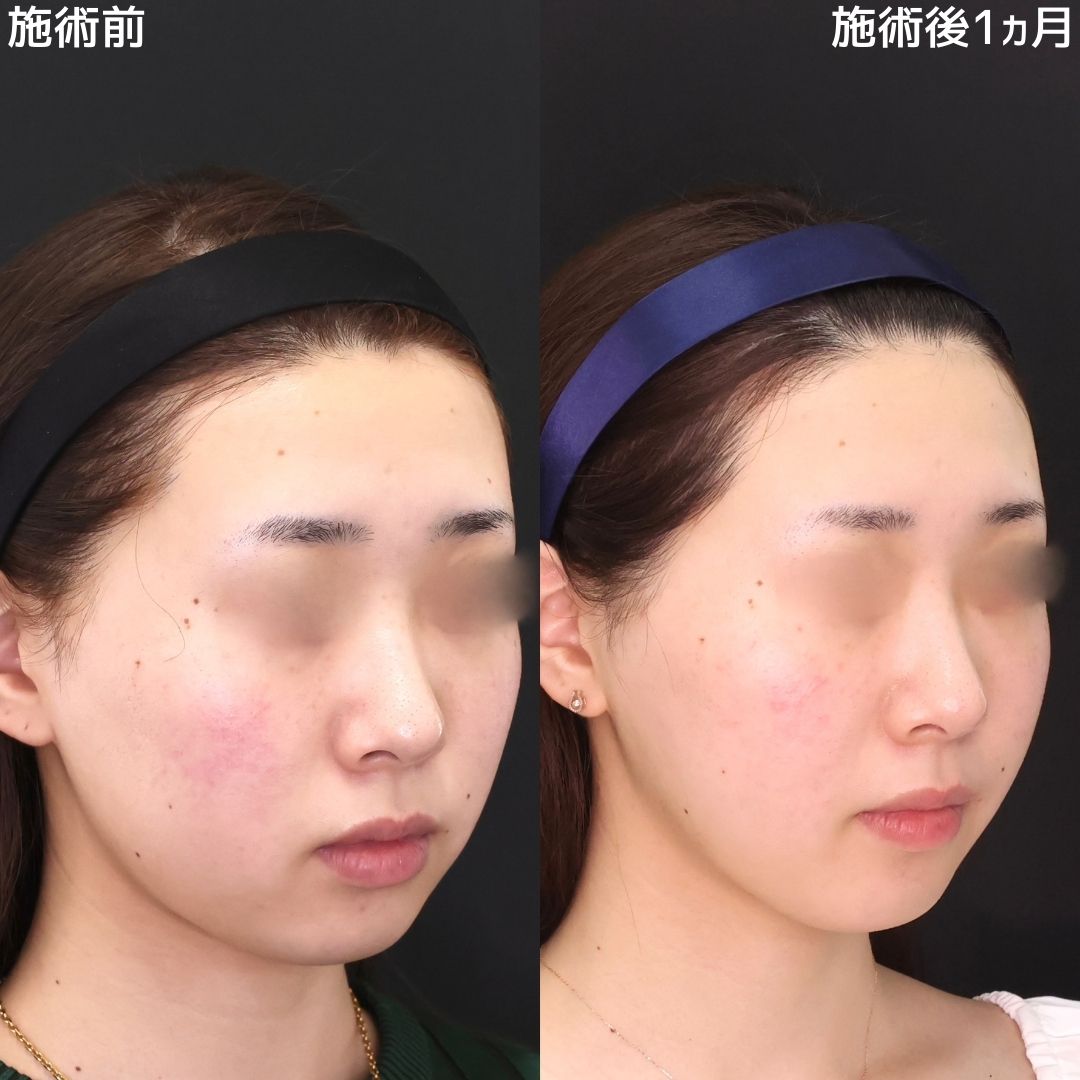 スッキリとした小顔で首の長さup！