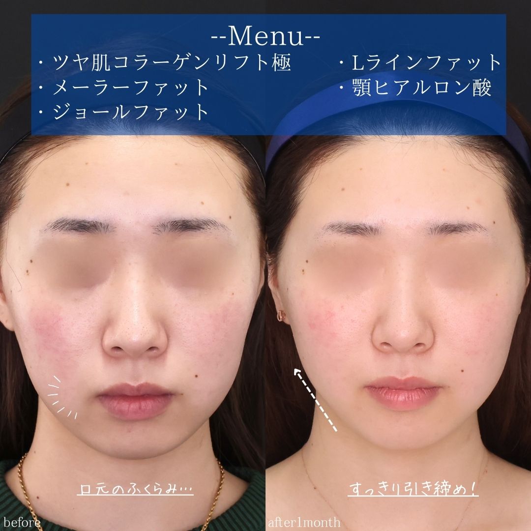 ジョールファット除去/メーラーファット除去/Lラインファット除去（エラ下脂肪除去）の症例写真 施術前後 