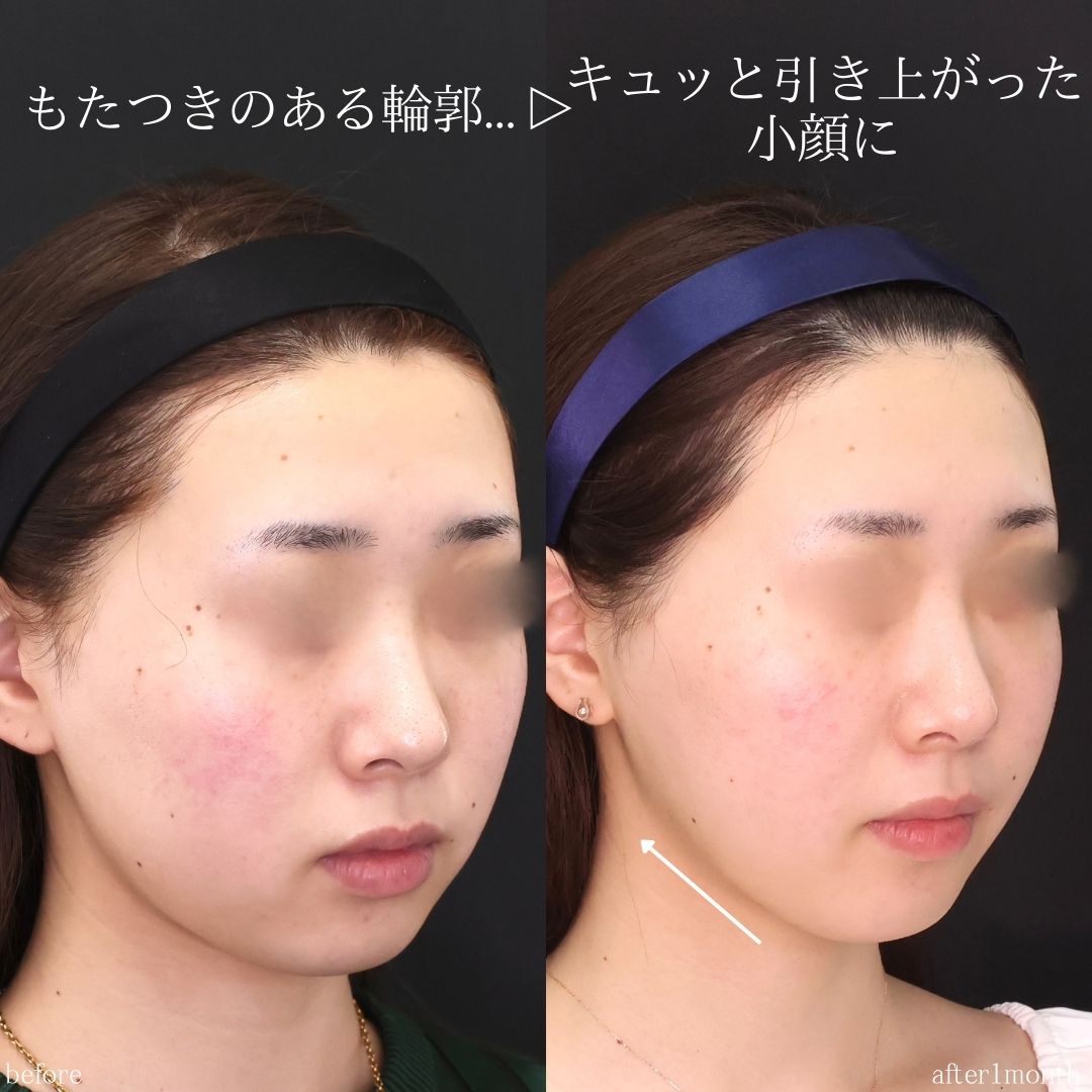 ジョールファット除去/メーラーファット除去/Lラインファット除去（エラ下脂肪除去）の症例写真 施術前後 