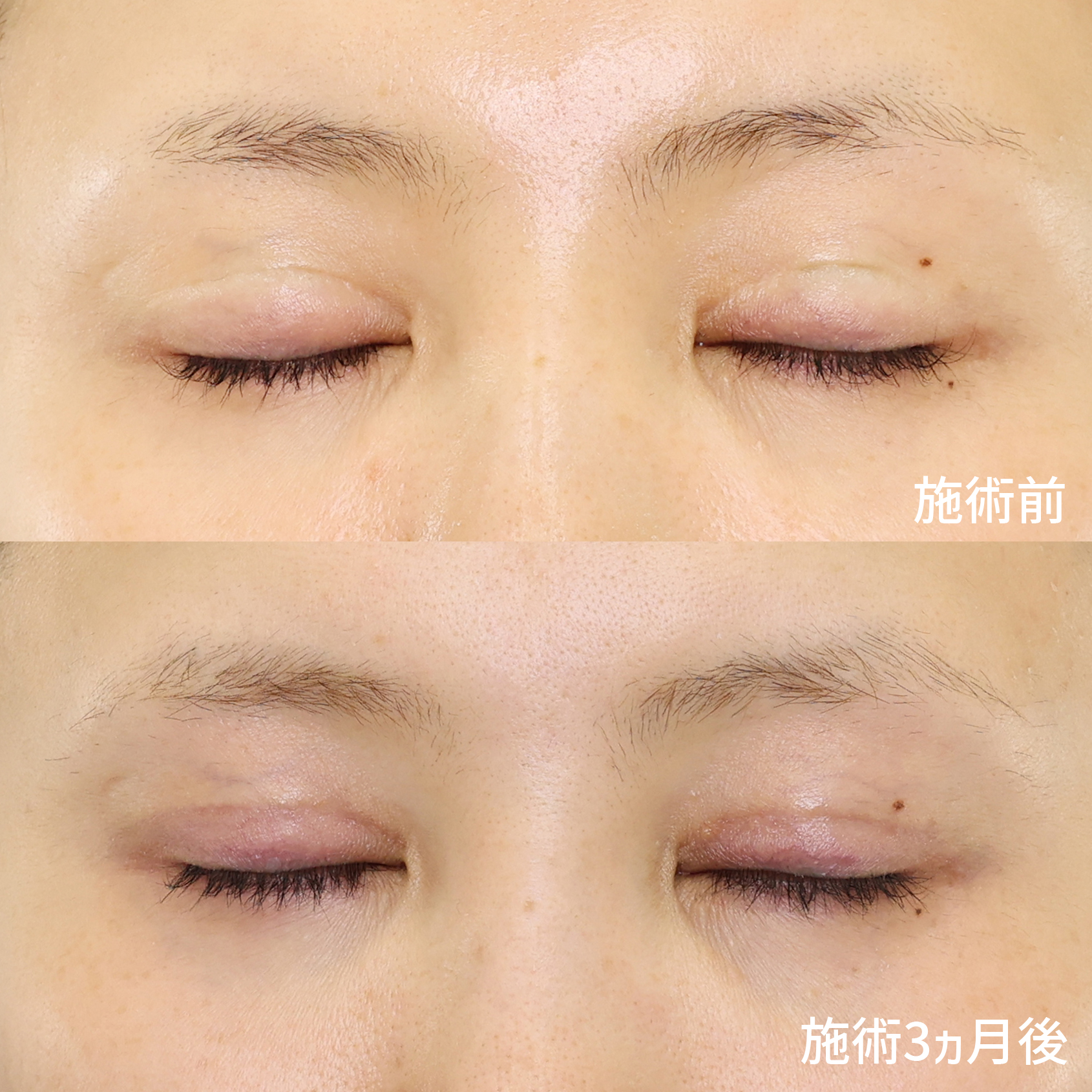 二重切開（全切開法）の症例写真 施術前後 