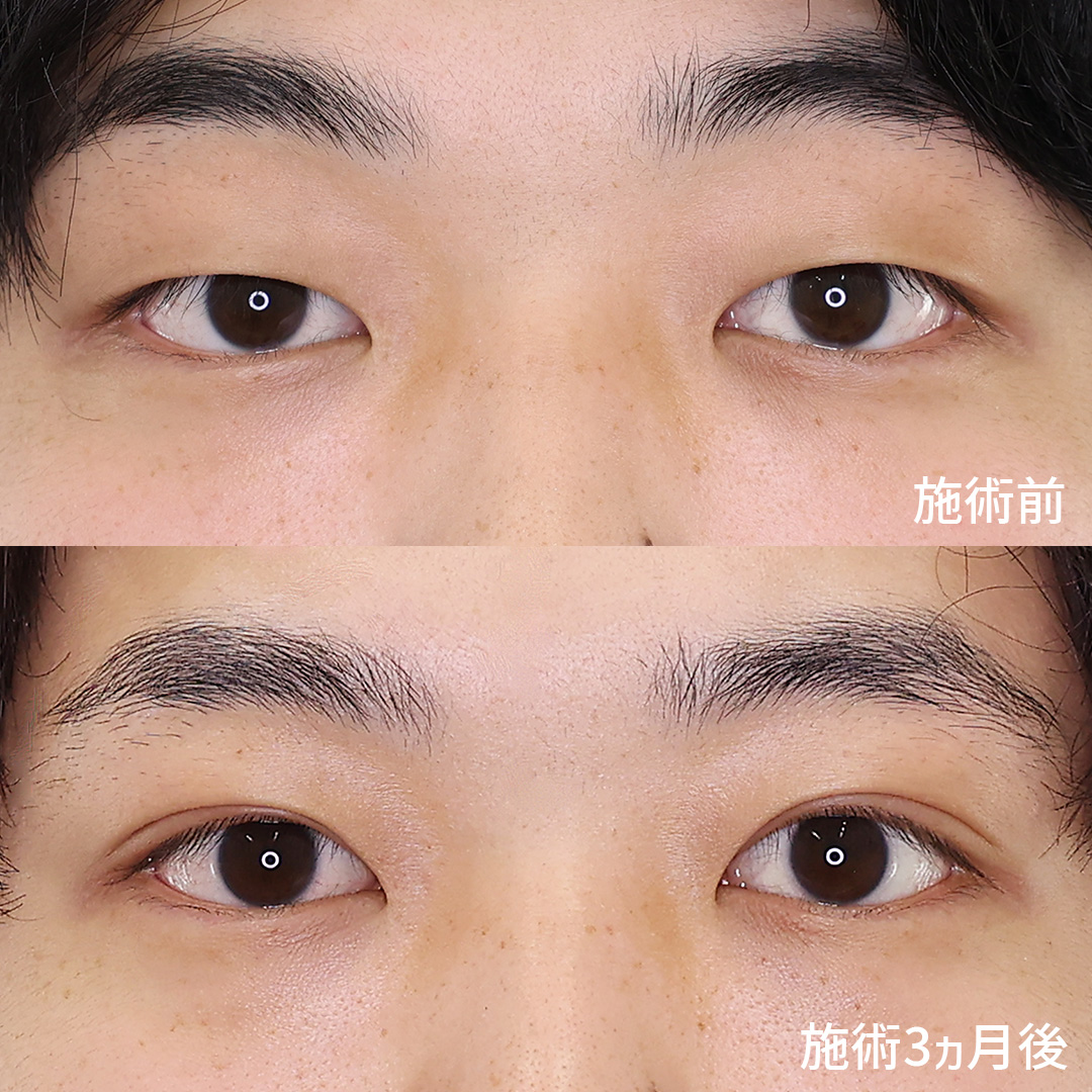 二重切開（全切開法）の症例写真 施術前後 