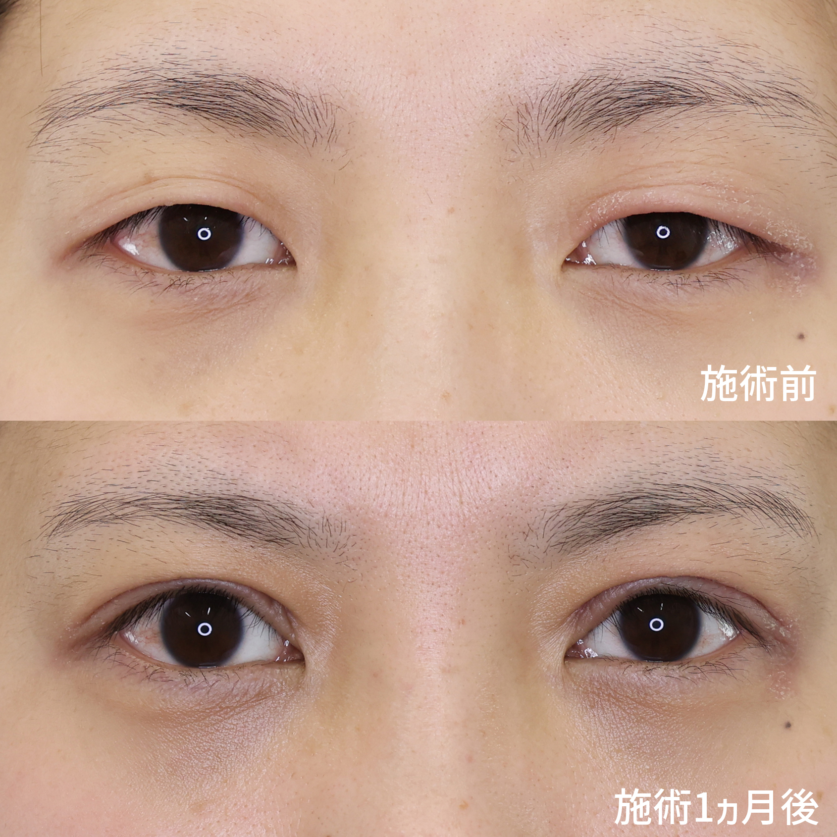【二重全切開＋眼瞼下垂】アイプチかぶれでお悩みの方必見！！伸びきった瞼を蘇らせる