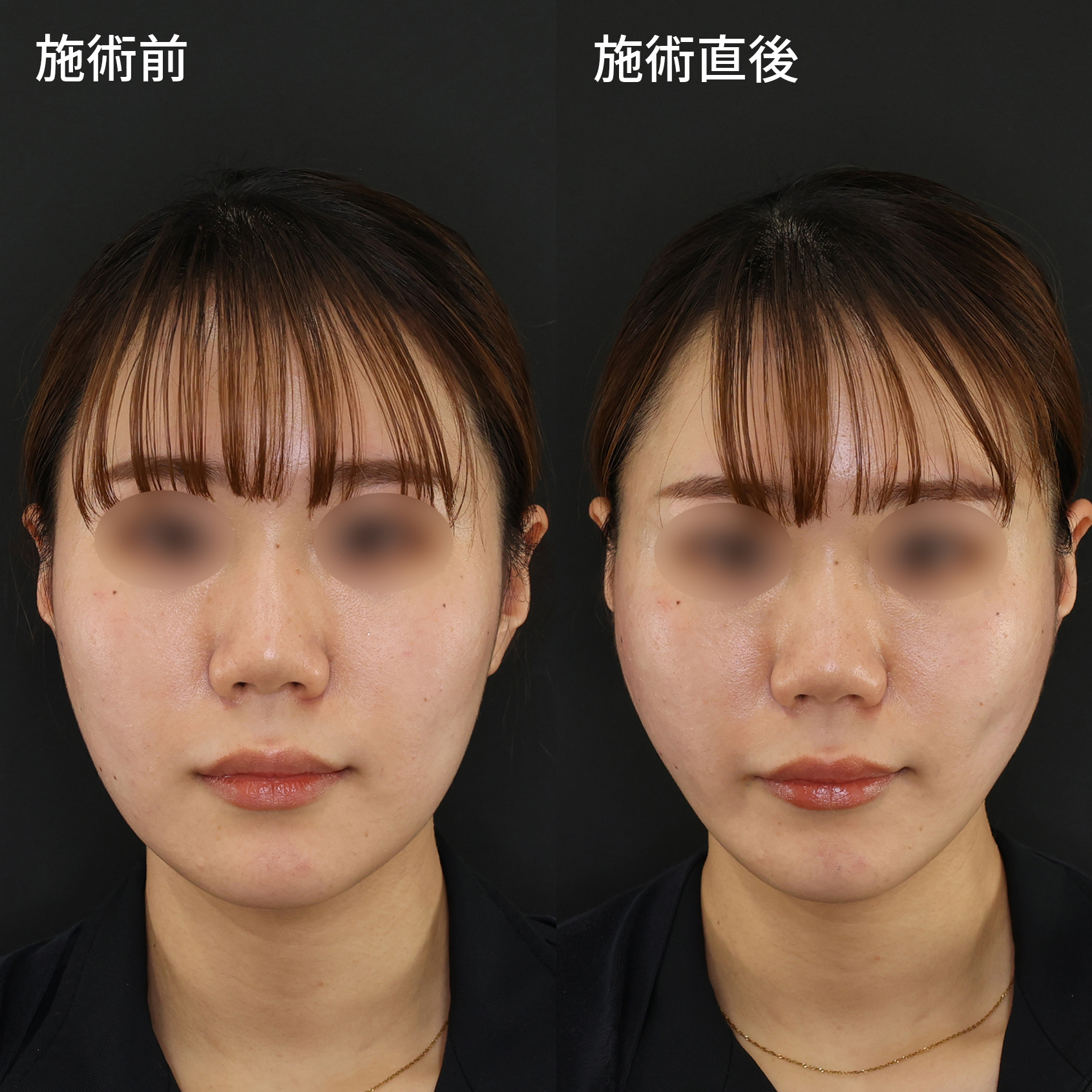 糸リフトで施術直後から卵型のフェイスラインに！！【小顔】