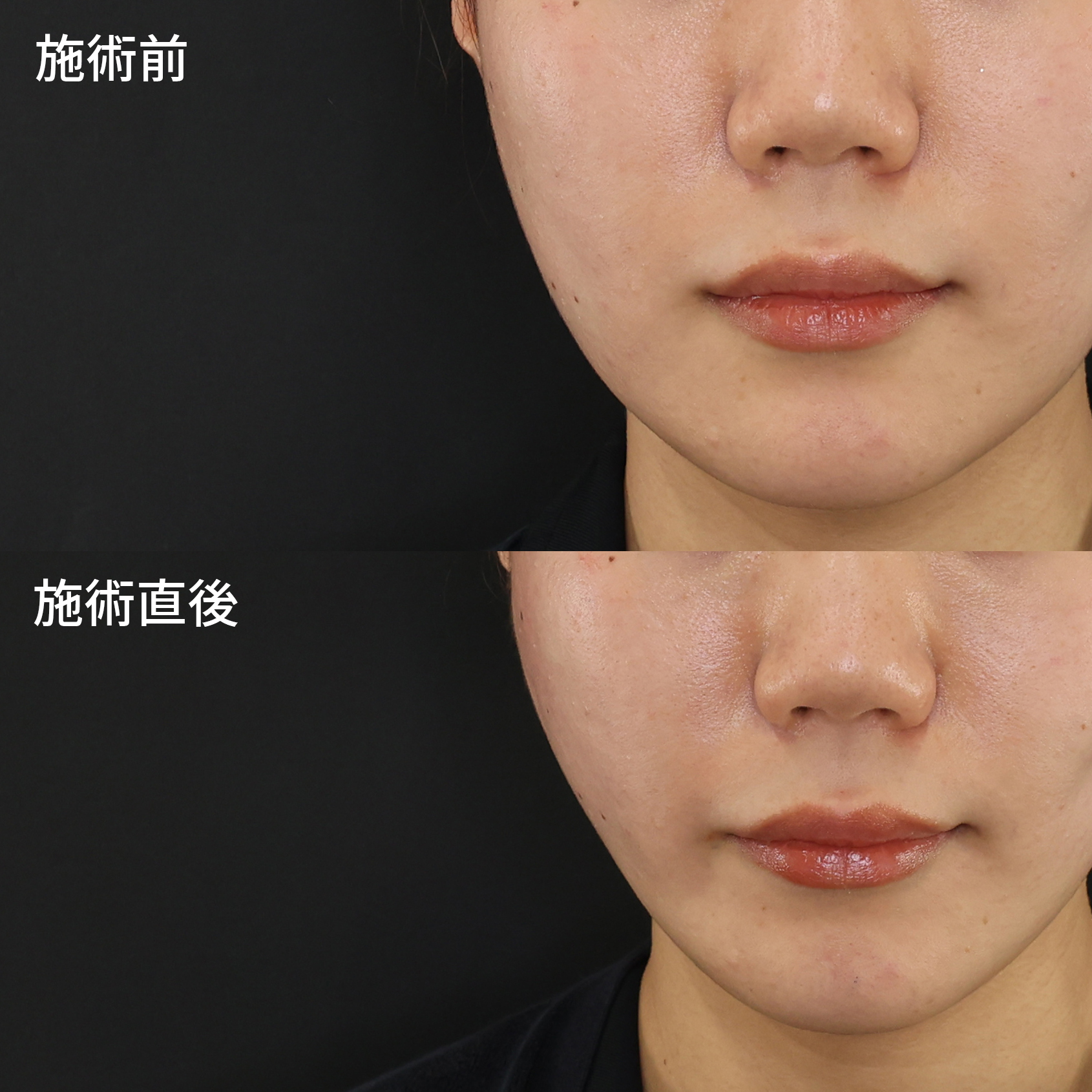 TAC式 ツヤ肌コラーゲンリフト®の症例写真 施術前後 