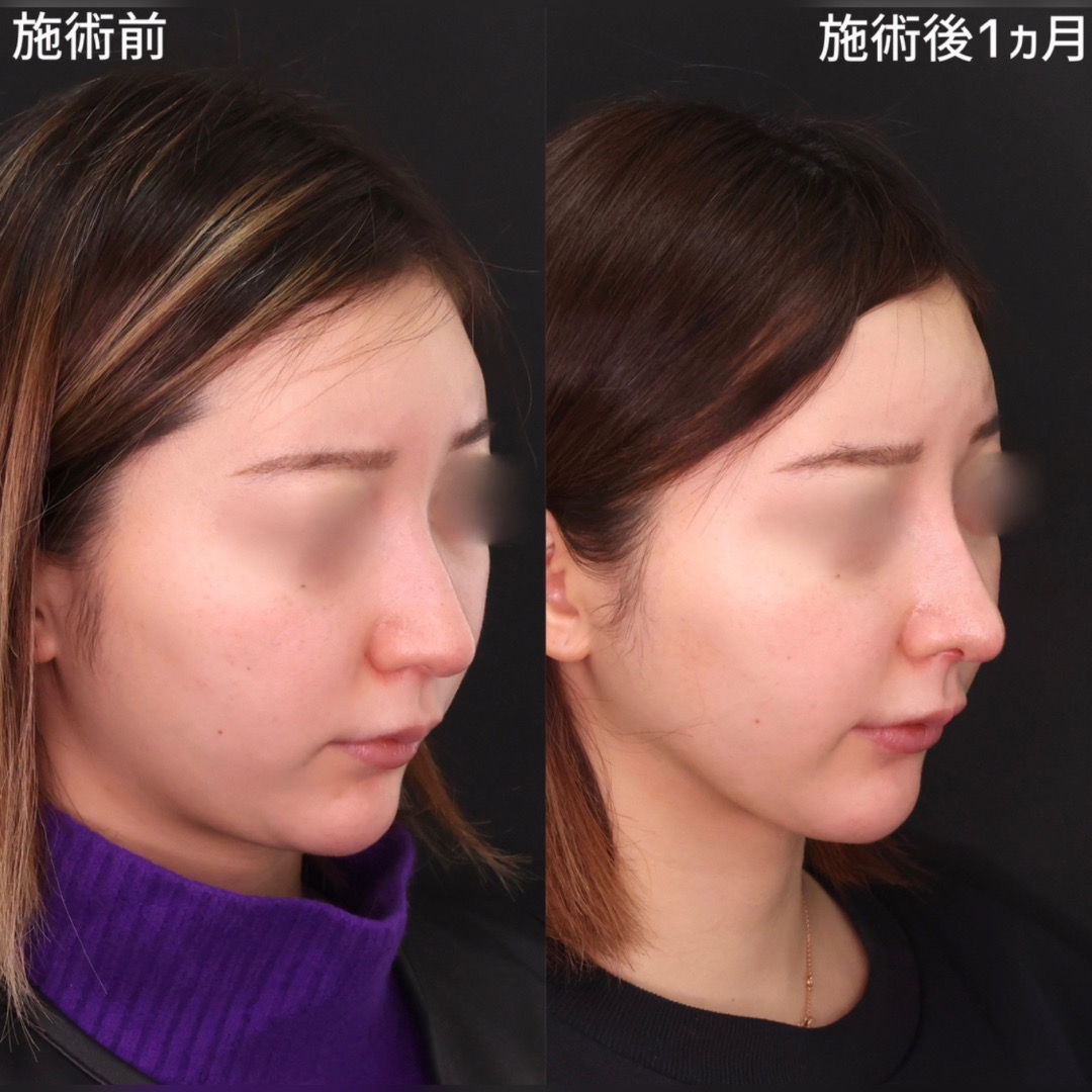 鼻尖形成・鼻尖縮小/鼻中隔延長術/隆鼻術（プロテーゼ・自家組織）の症例写真 施術前後 